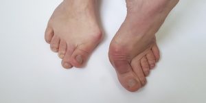 Juanetes (hallux valgus)