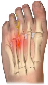 Neuroma de Morton