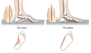 Pie plano y pie cavo